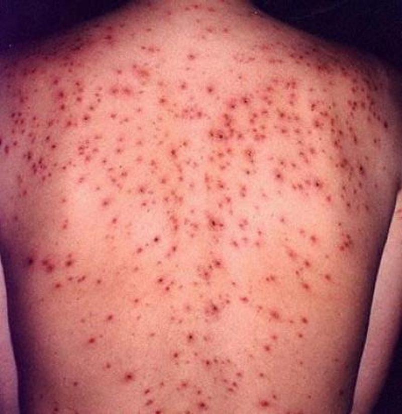 Pictures of Viral Skin Diseases and Problems- Rubella
