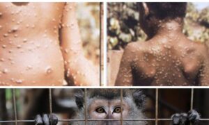 Încă un caz de variola maimuței, în România